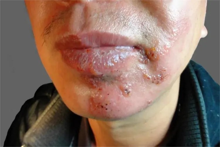 局部带状疱疹图片