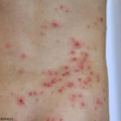 类天疱疮会怎么样