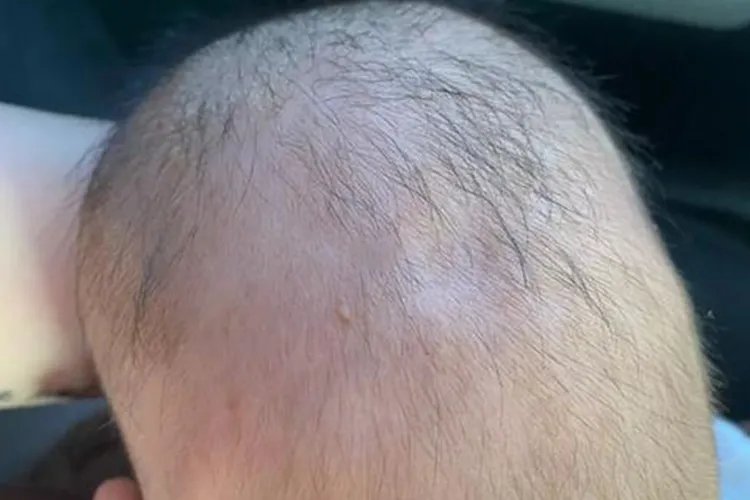 婴儿前囟门凹陷图片