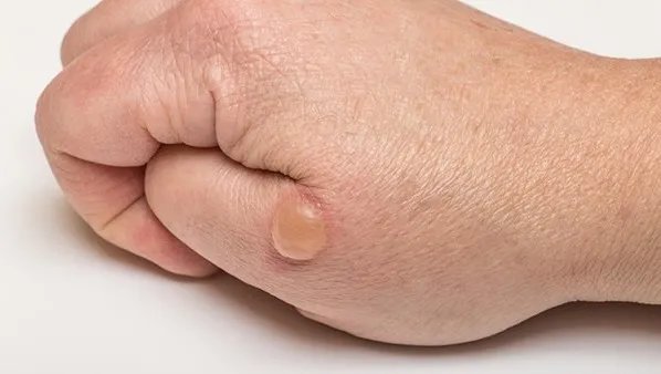 带状疱疹传染吗