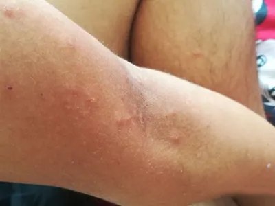 跳蚤叮咬小疙瘩图片