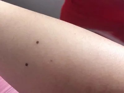 交界痣黑痣图片