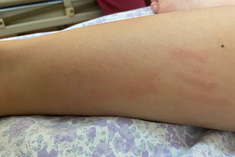 各种荨麻疹图片大全