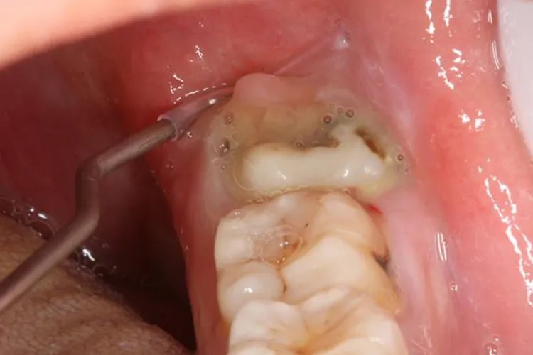 急性智齿冠周炎症状图片