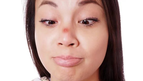 鼻子上长痘痘是什么原因