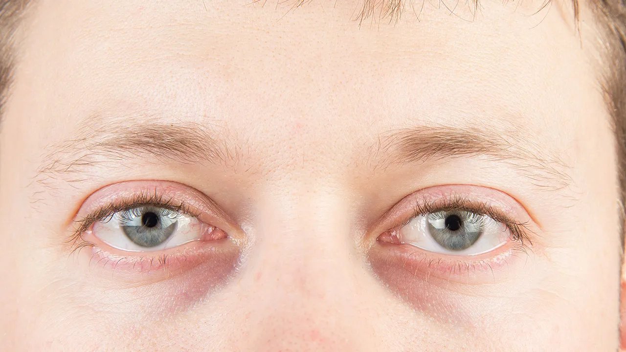 去除眼部皱纹方法