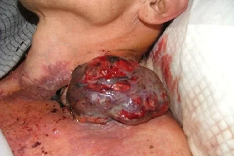 黑素瘤症状图片