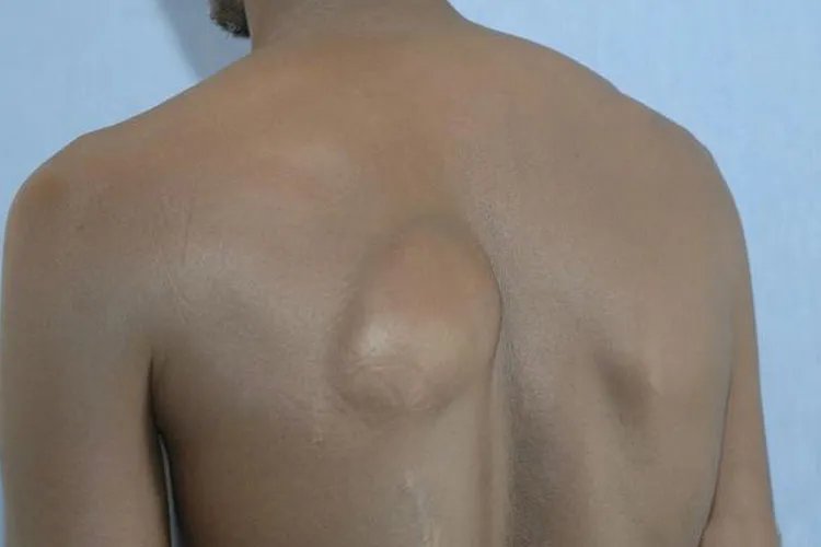 皮下脂肪瘤图片