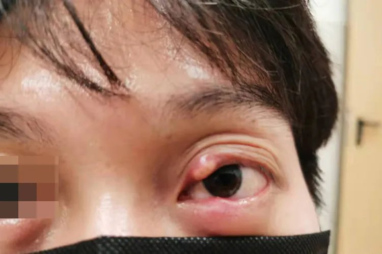 上眼皮红肿痒图片