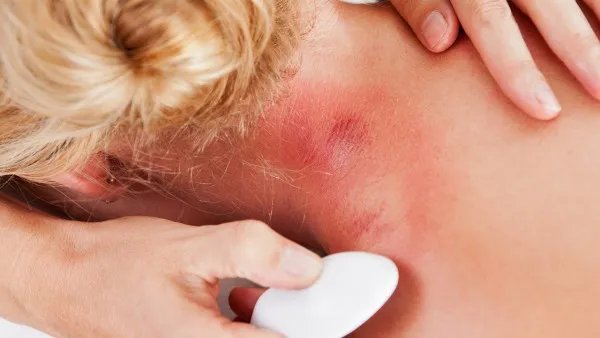 左旋咪唑是治疗什么疾病的药  左旋咪唑怎么使用效果好