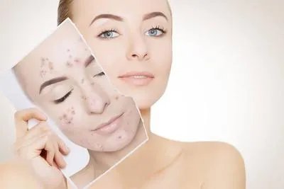 下巴长痘的原因都有哪些 下巴长痘或是这些原因惹的祸