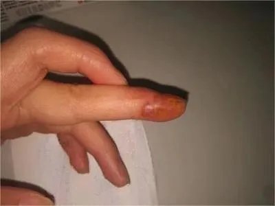 单纯疱疹水疱图片