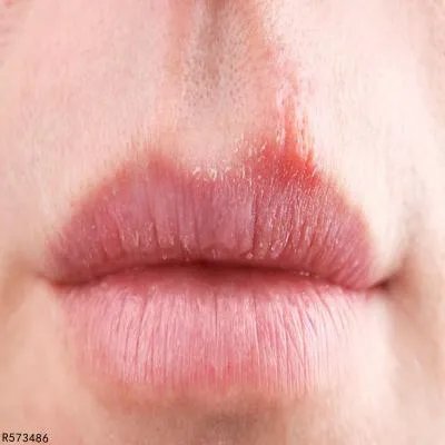 脓疱疮治疗多少钱