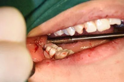 拔牙后七天窟窿恢复图