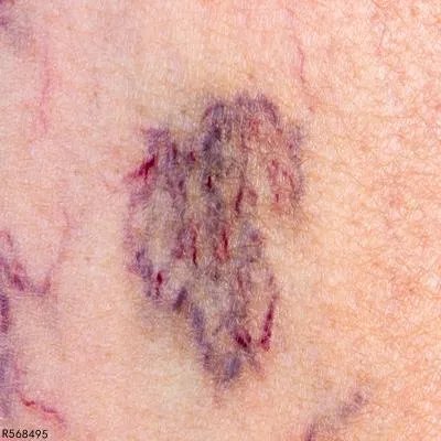 色素性紫癜性皮肤病是怎么引起的