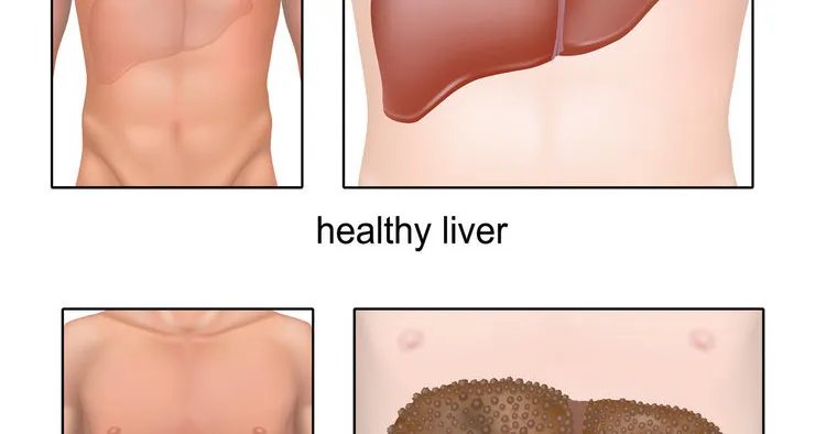 中医杨宏志：肝硬化有5种病因，对症治疗是关键