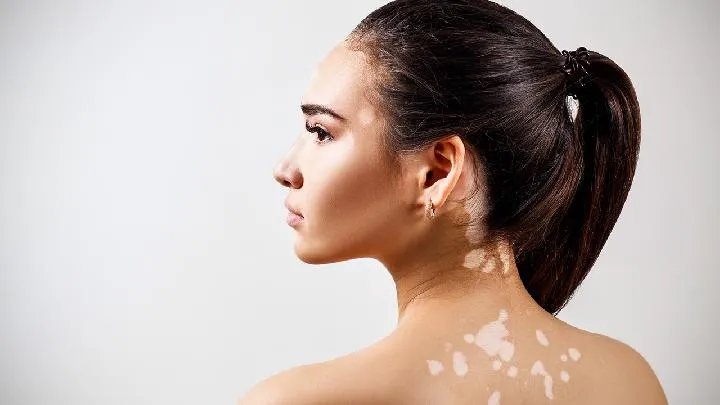 白癜风能治愈吗？怎么治？