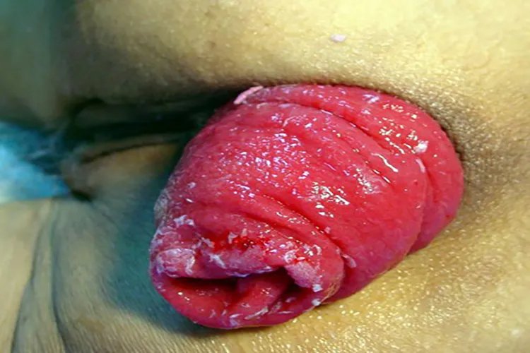 脱肛的症状和图片