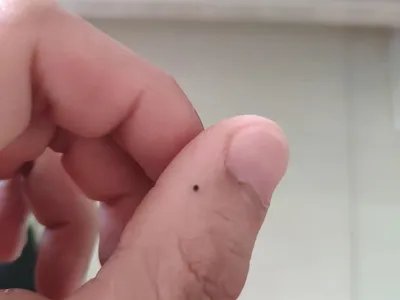 交界痣黑痣图片