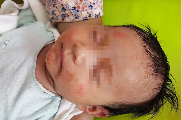 常见皮肤病对照图