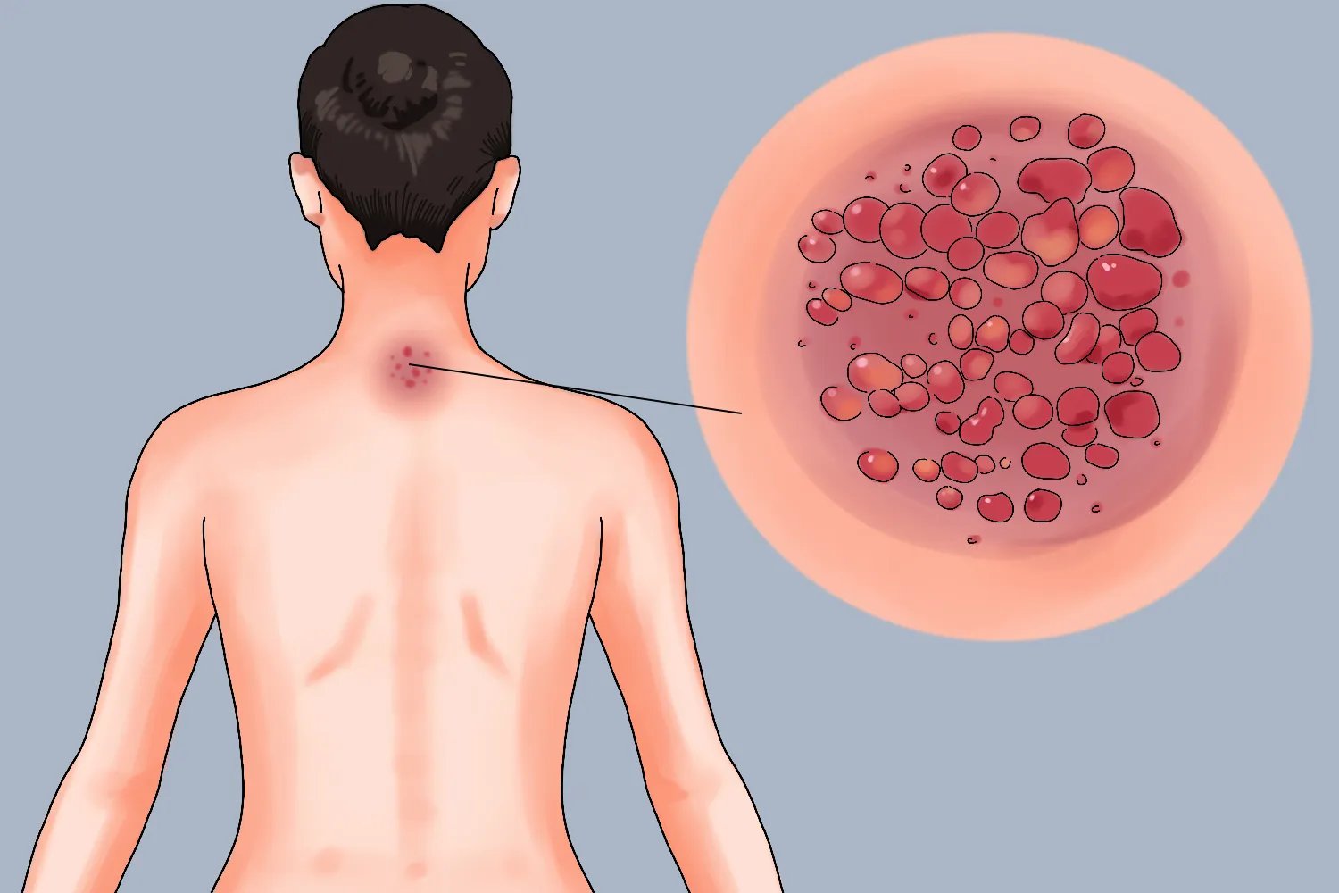 女人拔罐后湿气重图片