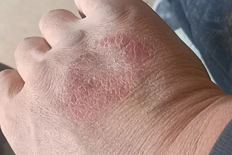湿疹手部症状图片