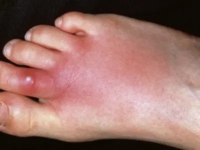 蜂窝织炎红肿图片