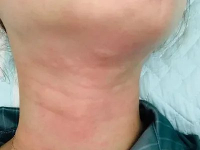 运动诱导性荨麻疹症状图片