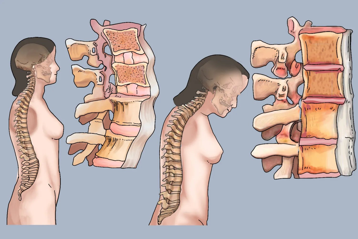强直性脊柱炎有什么样的症状