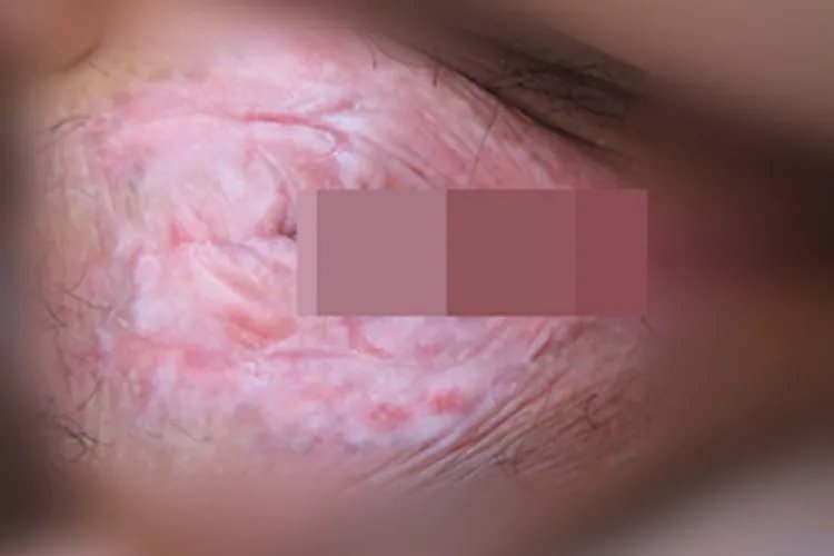 外阴白色病变症状图片