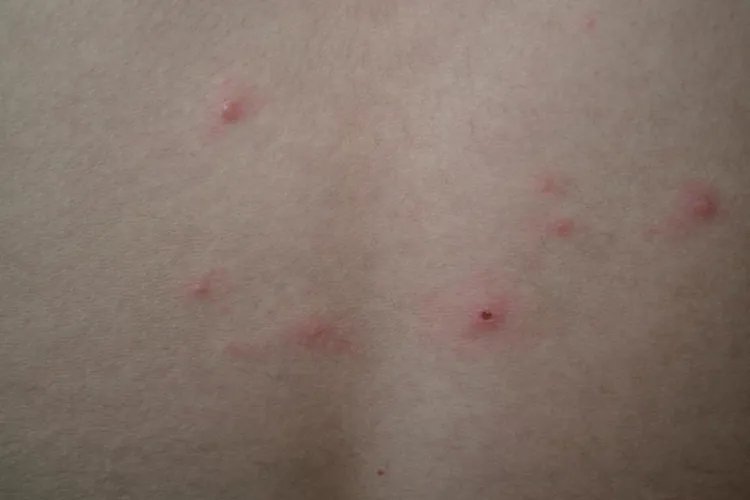 水痘图片长什么样子