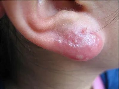 单纯疱疹水疱图片