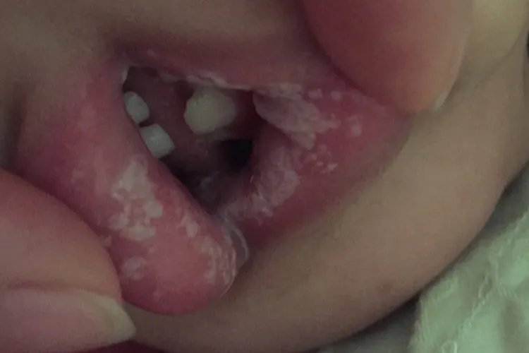 鹅口疮的图片
