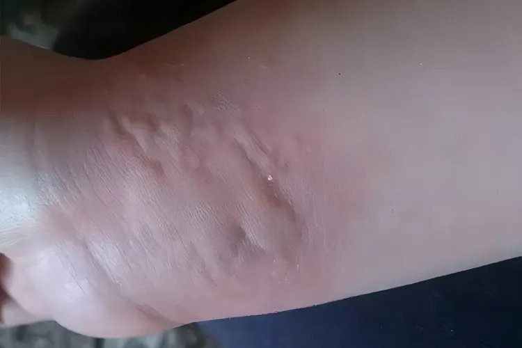 5种荨麻疹症状分析图片