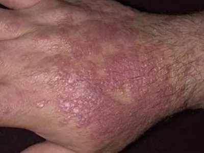 扁平苔藓斑图片