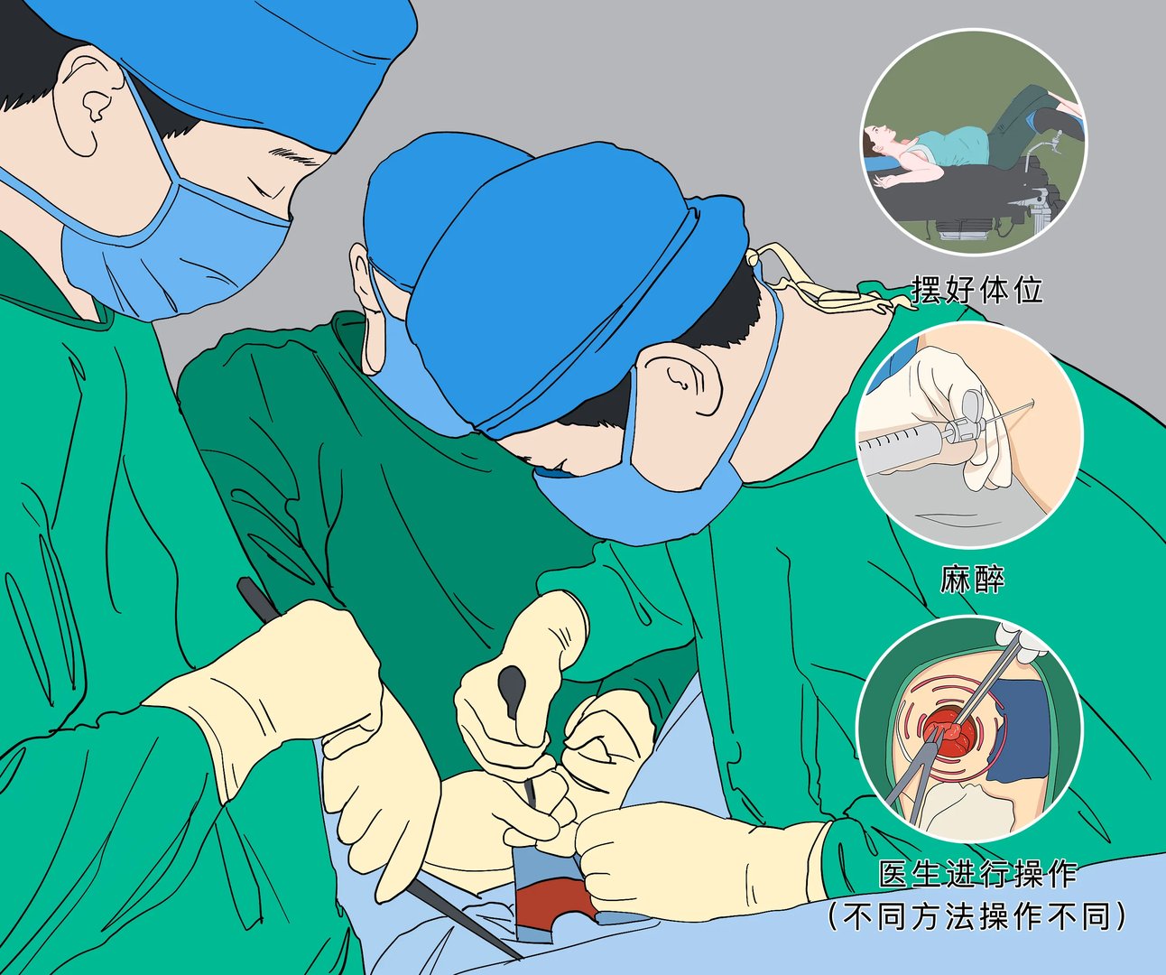 痔疮手术怎么做