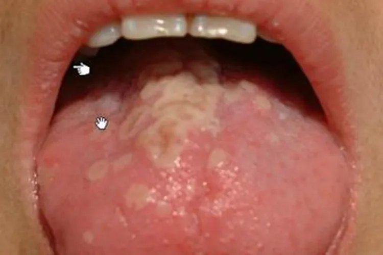 小儿手足口病最早期图片