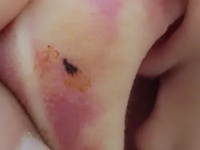 交界痣黑痣图片