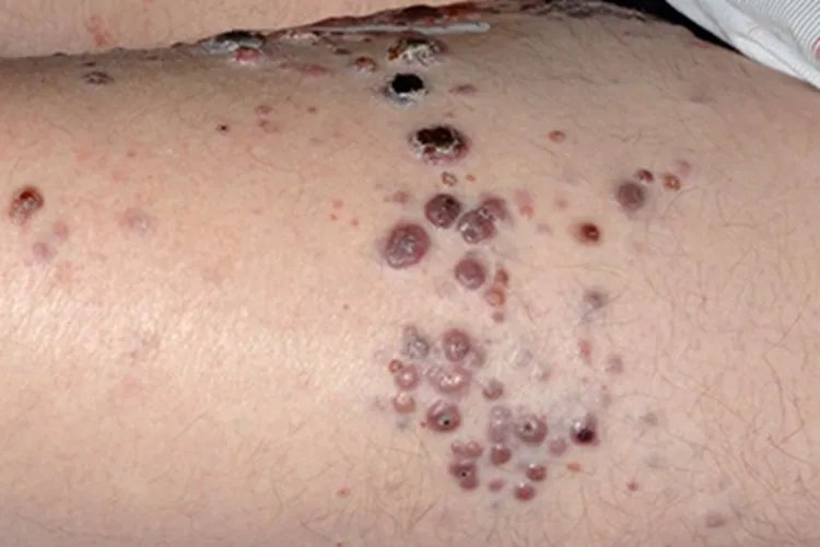 黑素瘤症状图片