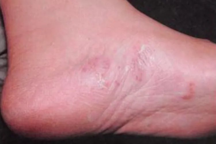脚部皮炎图片和症状