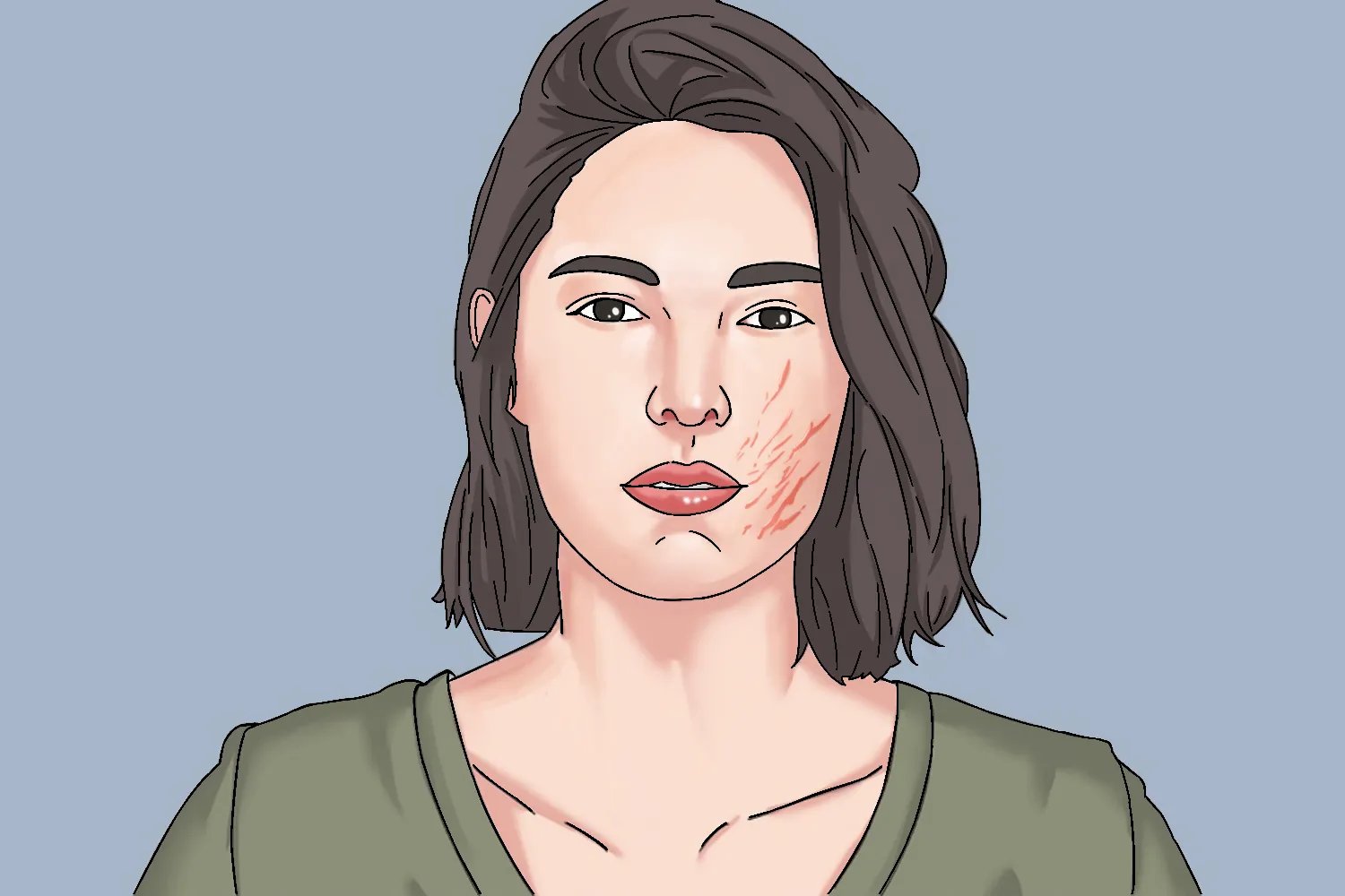 脸上长肥胖纹图片