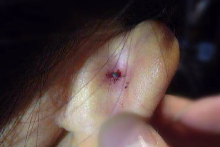 被蜱虫咬后十天伤口的图片