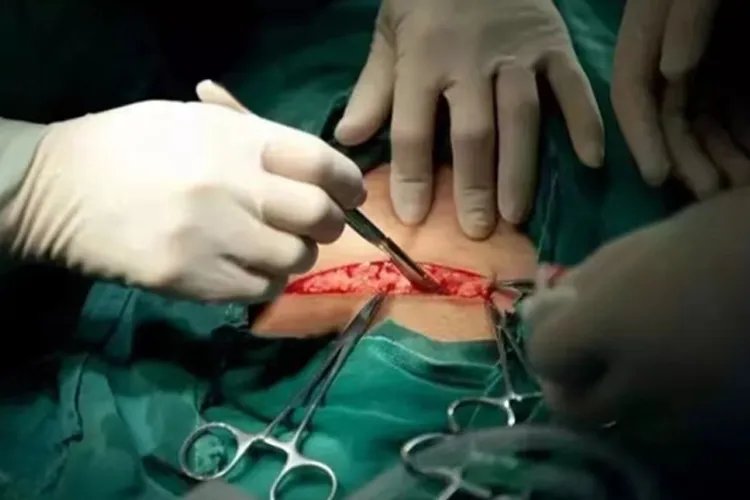 剖腹产7层全过程图片