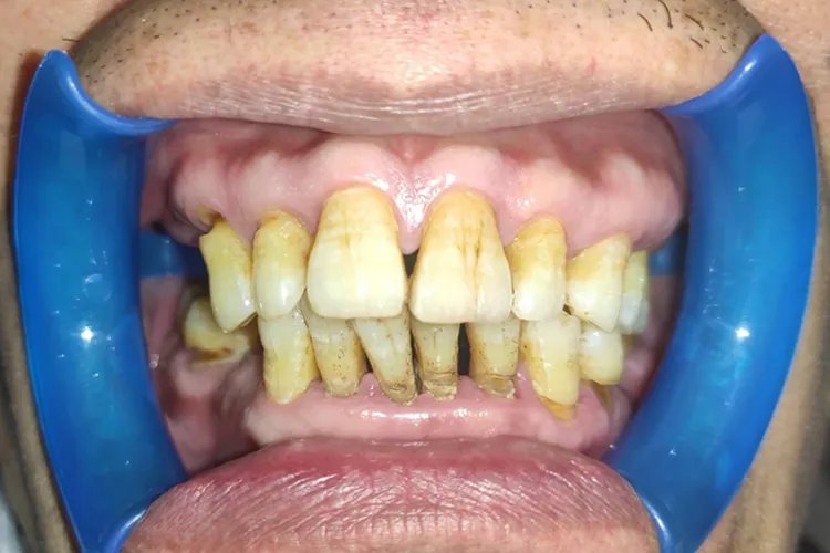 牙周病图片与正常牙齿图片