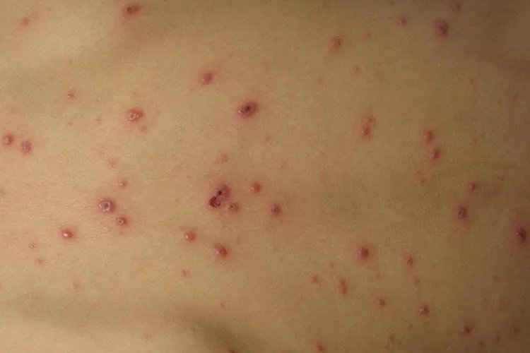 水痘图片长什么样子