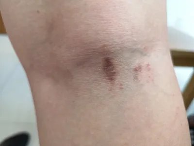 扁平苔藓斑图片