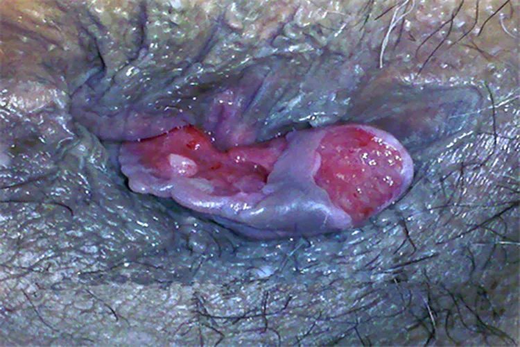 脱肛的症状和图片