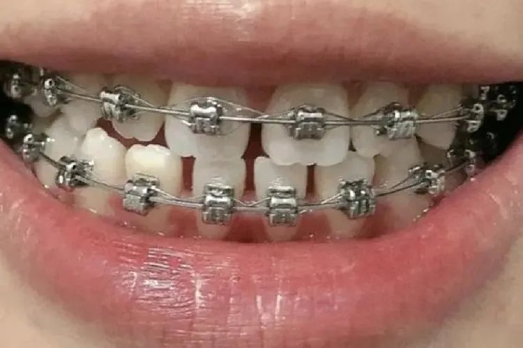 牙套分几种类型图片，有什么区别