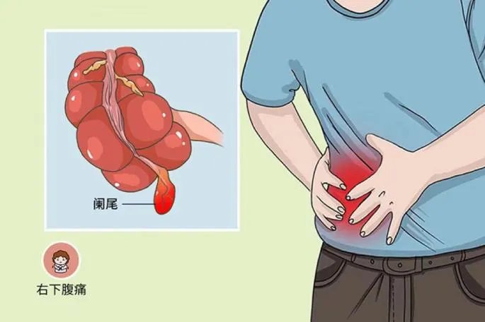 慢性阑尾炎疼痛位置图