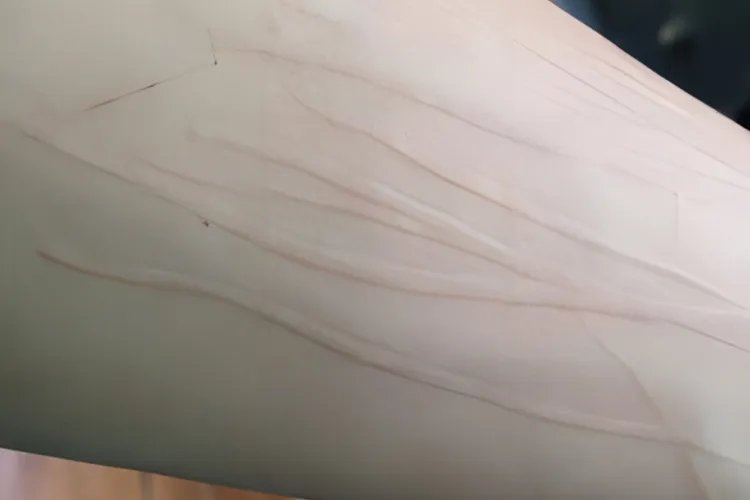 5种荨麻疹症状分析图片